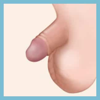 Circumcision in Southern Highlands Bowral Wollongong
